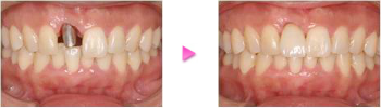 前歯のインプラントの治療例の写真