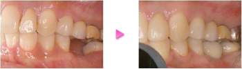 奥歯のインプラントの治療例の写真