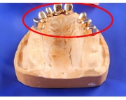 コーヌス義歯の写真1