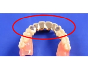 コーヌス義歯の写真2