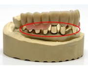 コーヌス義歯の写真3