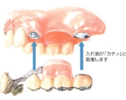 磁石式入れ歯の写真