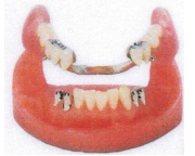 コーヌス義歯の写真