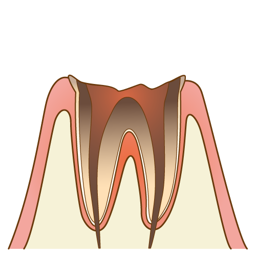 C4（歯の根元だけが残った虫歯）のイラスト