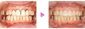上顎前歯セラミック治療の治療例の写真