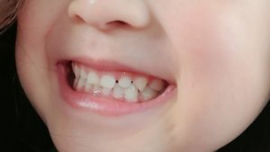 子供の歯の写真