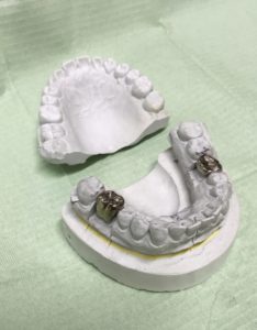 銀歯の写真